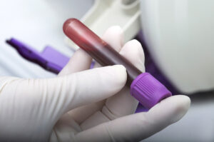 How Ahmed & Sukaram, Attorneys at Law, Can Help With a DUI Blood Test in San Jose